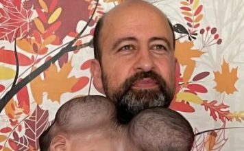 Od jedne glave do dva odvojena života: kako su Manal i Mirha dobile novu šansu poslije zahtjevne operacije