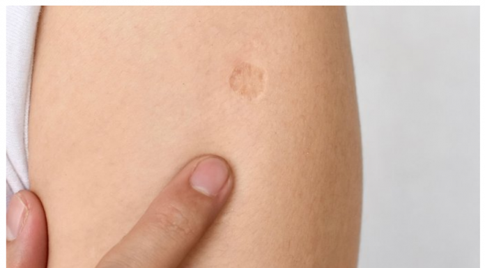 SVI KOJI SU ROĐENI U JUGOSLAVIJI IMAJU OVAJ OŽILJAK NA RUCI: Znate li kako je nastao i zbog čega? SVI SU IZNENAĐENI