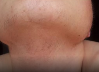 ZNATE LI ZAŠTO SE KOD ŽENA JAVLJAJU DLAČICE NA BRADI? Evo šta je uzrok dlakavosti lica kod žena!