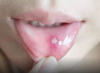 Ako ste ikada imali OVO u ustima, trebali bi znati šta je u pitanju, i kako da se toga riješite..