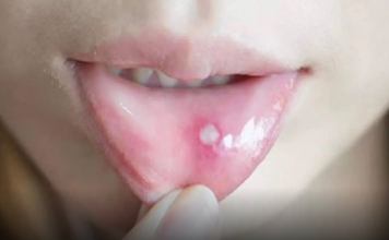 Ako ste ikada imali OVO u ustima, trebali bi znati šta je u pitanju, i kako da se toga riješite..