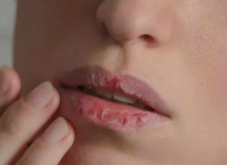 Nedostatak željeza u krvi: 6 neobičnih simptoma koji mogu ukazivati na anemiju