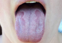 Kandida uništava organizam