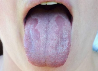 Kandida uništava organizam