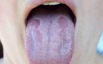 Kandida uništava organizam