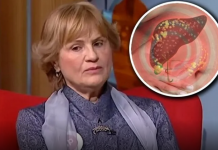 DOKTORKA RADMILA OTKILA KOJE SU NAJBOLJE NAMIRNICE ZA MASNU JETRU: Ono što je rekla o SURUTKI, mnoge će Š0KIRATI