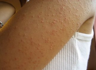 EVO ZAŠTO IMATE “PUREĆU KOŽU”: Žene često imaju ovaj problem!