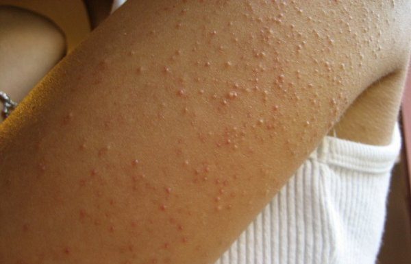 EVO ZAŠTO IMATE “PUREĆU KOŽU”: Žene često imaju ovaj problem!