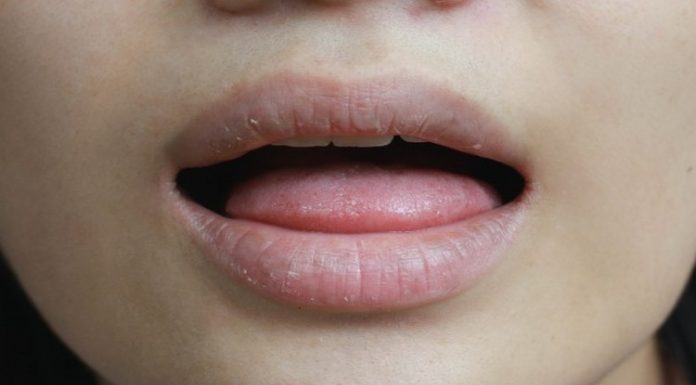 NE ZANEMARUJTE OVAJ SIMPTOM! Evo šta znače suha usta!