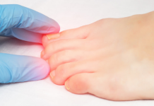 IMATE URASLI NOKAT?! – Ovako za samo 2 minute riješite nelagodu i bol!