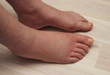 Potreban vam je JEDAN vitamin da biste se riješili viška vode: noge vam više neće oticati, samo ga uključite u prehranu