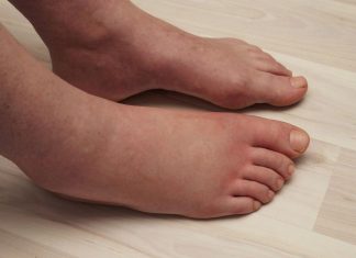 Potreban vam je JEDAN vitamin da biste se riješili viška vode: noge vam više neće oticati, samo ga uključite u prehranu