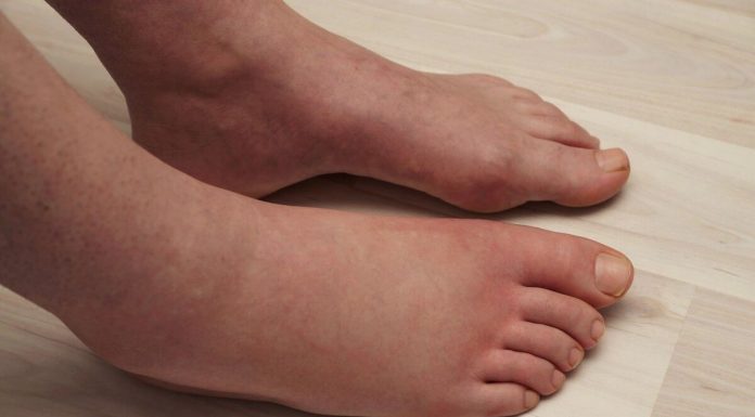 Potreban vam je JEDAN vitamin da biste se riješili viška vode: noge vam više neće oticati, samo ga uključite u prehranu