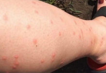 KOMARCI VAM PRAVE PAKAO OD ŽIVOTA? Samo isijecite OVO VOĆE na pola i ostavite u sobi, VIŠE IH NIKADA NEĆETE VIDJETI BLIZU!