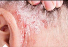 NE BACAJTE NI SLUČAJNO KORU OD OVE VOĆKE: Liječi psorijazu, skida bradavice i izbeljuje zube