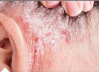 NE BACAJTE NI SLUČAJNO KORU OD OVE VOĆKE: Liječi psorijazu, skida bradavice i izbeljuje zube