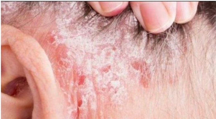 NE BACAJTE NI SLUČAJNO KORU OD OVE VOĆKE: Liječi psorijazu, skida bradavice i izbeljuje zube