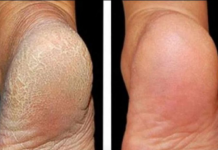 Za meka stopala potrebna su vam samo 3 kuhinjska sastojka: Samo potopite noge u OVU SMJESU