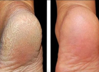 Za meka stopala potrebna su vam samo 3 kuhinjska sastojka: Samo potopite noge u OVU SMJESU