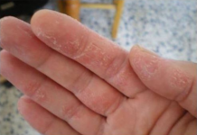 PUCANJE KOŽE, TRNCI ILI OPADANJE KOSE SU PRVI ZNAKOVI: Evo šta vam tijelo govori!