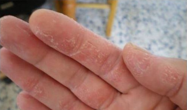 PUCANJE KOŽE, TRNCI ILI OPADANJE KOSE SU PRVI ZNAKOVI: Evo šta vam tijelo govori!