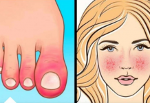 10 Znakova AUTOIMUNIH BOLESTI: Ovo su simptomi da tijelo samo sebe uništava