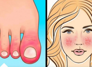 10 Znakova AUTOIMUNIH BOLESTI: Ovo su simptomi da tijelo samo sebe uništava