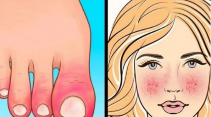 10 Znakova AUTOIMUNIH BOLESTI: Ovo su simptomi da tijelo samo sebe uništava