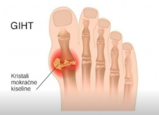 Tri narodna lijeka za giht kojima je cilj eliminirati mokraćnu kiselinu iz tijela: Ovo predstavlja potencijalno rješenje za one koji traže olakšanje