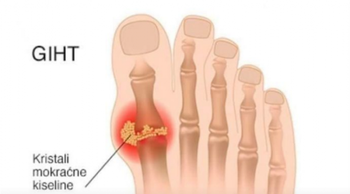Tri narodna lijeka za giht kojima je cilj eliminirati mokraćnu kiselinu iz tijela: Ovo predstavlja potencijalno rješenje za one koji traže olakšanje