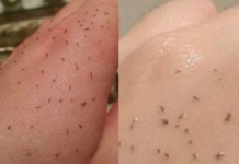 MITESERI SAMI ISPADAJU IZ PORA: Uz ova DVA sastojka koja već imate u kući OČISTITE LICE DO SAVRŠENSTVA!