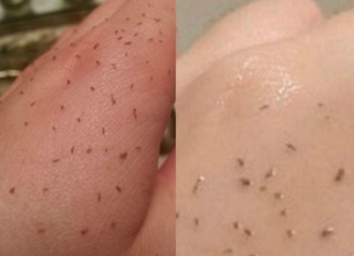 MITESERI SAMI ISPADAJU IZ PORA: Uz ova DVA sastojka koja već imate u kući OČISTITE LICE DO SAVRŠENSTVA!