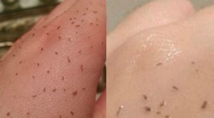 MITESERI SAMI ISPADAJU IZ PORA: Uz ova DVA sastojka koja već imate u kući OČISTITE LICE DO SAVRŠENSTVA!