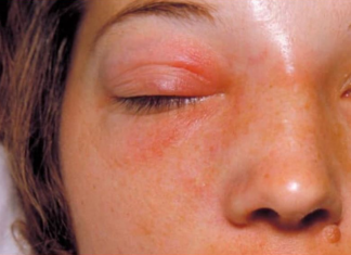 NAJMOĆNIJI PRIRODNI LIJEK ZA SINUSE, OD SAMO 2 SASTOJKA: Prodisat ćete za tren oka