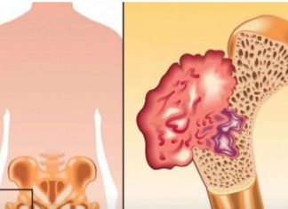 BOL U KOSTIMA, VISOK PRITISAK I TUGA: Simptomi da vam u tijelu nedostaje VAŽAN VITAMIN