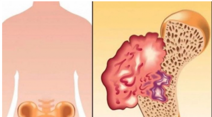 BOL U KOSTIMA, VISOK PRITISAK I TUGA: Simptomi da vam u tijelu nedostaje VAŽAN VITAMIN