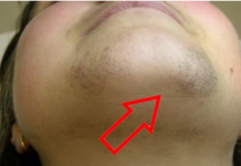 Kako ukloniti dlake sa lica na prirodan i jednostavan način: Epilacija kod kuće!