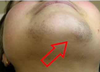 Kako ukloniti dlake sa lica na prirodan i jednostavan način: Epilacija kod kuće!