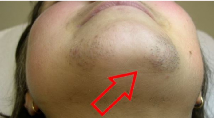 Kako ukloniti dlake sa lica na prirodan i jednostavan način: Epilacija kod kuće!