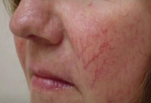 PAUČASTE VENE NA LICU SU ZNAK UPOZORENJA: Ako ih imate, mogle bi ukazivati na OVU BOLEST