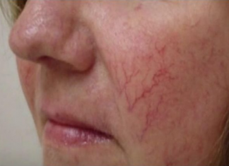 PAUČASTE VENE NA LICU SU ZNAK UPOZORENJA: Ako ih imate, mogle bi ukazivati na OVU BOLEST