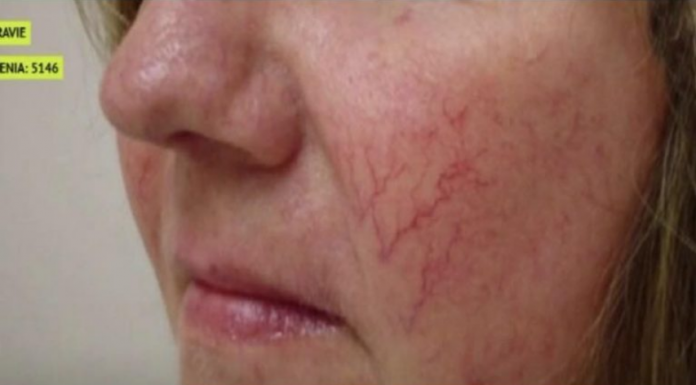 PAUČASTE VENE NA LICU SU ZNAK UPOZORENJA: Ako ih imate, mogle bi ukazivati na OVU BOLEST