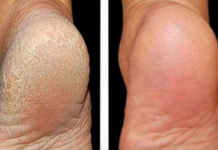 Za meka stopala potrebna su vam samo 3 kuhinjska sastojka: Potopite noge u ovu smjesu i recite zbogom ispucalim petama