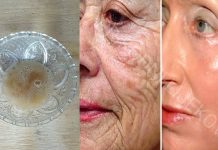 VJEROVALI ILI NE – SIRĆE VAM MOŽE POMOĆI DA SE RIJEŠITE BORA, AKNI I STARAČKIH PJEGA