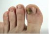 Ovo je najbolji lijek za onihomikozu: pomiješajte ove sastojke i potopite prste i nestat će preko noći