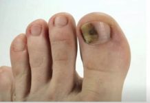 Ovo je najbolji lijek za onihomikozu: pomiješajte ove sastojke i potopite prste i nestat će preko noći