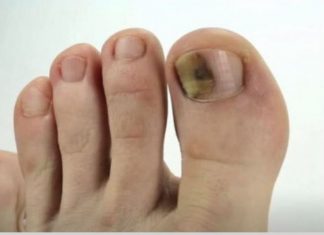Ovo je najbolji lijek za onihomikozu: pomiješajte ove sastojke i potopite prste i nestat će preko noći