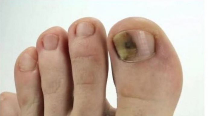 Ovo je najbolji lijek za onihomikozu: pomiješajte ove sastojke i potopite prste i nestat će preko noći
