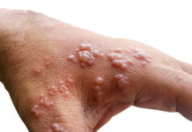 Najmoćniji PRIRODNI LIJEK za HERPES ZOSTER: uklonite ga zauvijek!