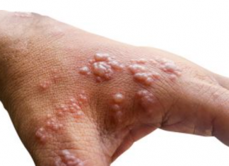 Najmoćniji PRIRODNI LIJEK za HERPES ZOSTER: uklonite ga zauvijek!